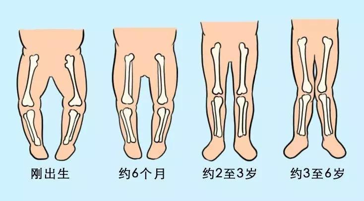 关于14个月宝宝O型腿的探讨与图片展示